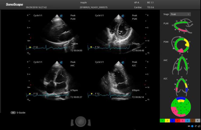 Stress Echo S60